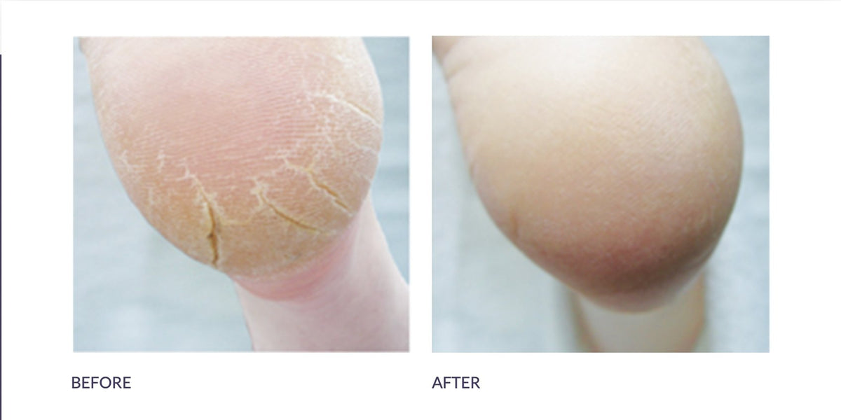 Footlogix Cracked Heel Formula - Blend Box
